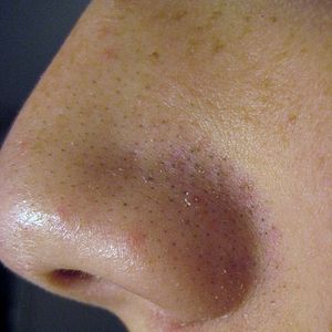 Pimples  Scars (pimples_acnescars)